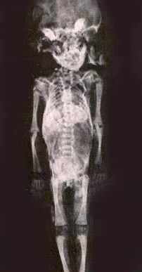 Рентгеновский снимок этой мумии