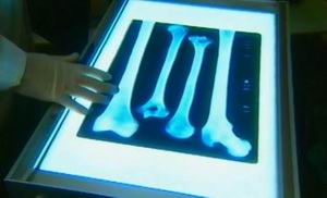 Рентген берцовых и бедренных костей скелета из КВ 55