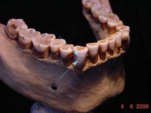 Гипоплазия зубов жителя Амарны